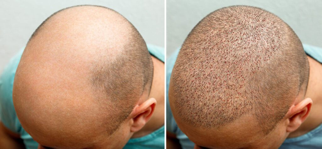Your Guide to Using Recent Customer Reviews to Find a Trusted Hair Transplant Clinic in London