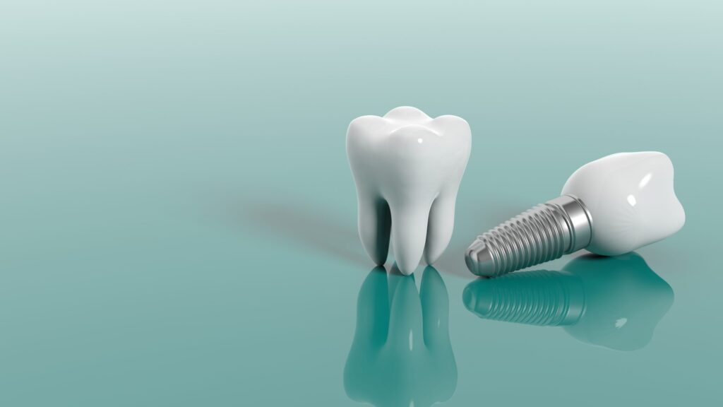 Dental Implants Milton Keynes: Why More People Are Choosing This Treatment