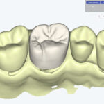 Why More Dental Clinics Are Standardising Restorations via a Dental CAD Hub